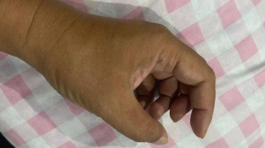 Sering Menggemeretakkan Jari Tangan, Bahayakah? Begini Kata Dokter