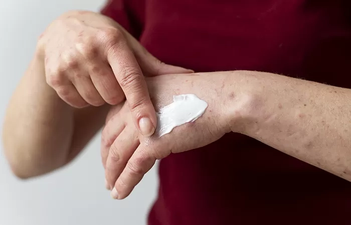 Rekomendasi Obat Pereda Gatal di Pantat Yang Dijual Bebas di Apotek dan Tidak Perlu Resep Dokter