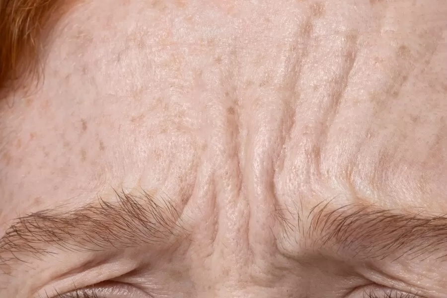 9 Cara Mudah yang Ampuh untuk Mencegah dan Mengurangi Keriput agar Kulit Tetap Cantik Awet Muda