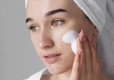 Ini Dia 7 Tips Untuk Mencegah Terjadinya Jerawat Batu yang Bisa Dilakukan di Rumah