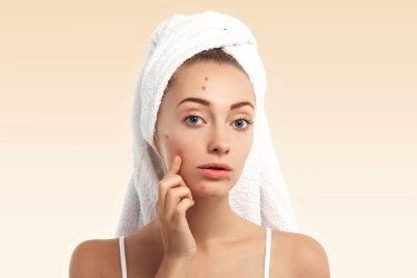 Acne Fighter Wajib Tahu! Begini 12 Tips Jitu untuk Mencegah Timbulnya Jerawat
