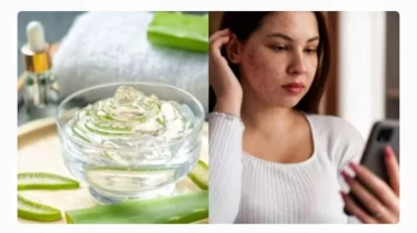 Apakah Benar Aloe Vera atau Lidah Buaya dapat Mengurangi Hiperpigmentasi? Simak Informasi Berikut Ini