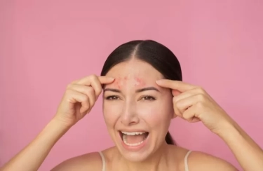 Jangan Abaikan! Jerawat Bisa Menjadi Tanda Kurangnya 4 Vitamin Penting Ini dalam Tubuh, Apa Saja?