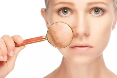 Stres Ternyata Bisa Bikin Kulit Kusam, Simak 7 Penyebab Lainnya