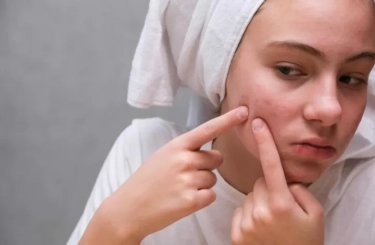 Jerawat Bernanah? Hindari 10 Kesalahan Fatal Ini yang Justru Dapat Memperburuk Kondisi Kulit Anda