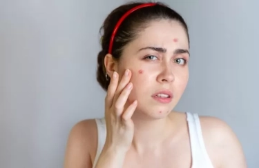 Waspadai, 6 Tanda Jerawat Akan Muncul di Wajah Anda, Segera Kenali Sebelum Terlambat!