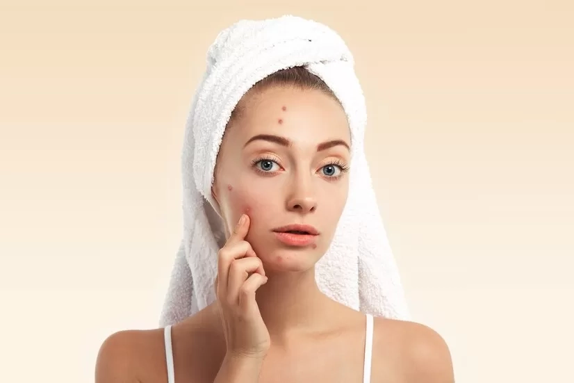 Dipercaya Dapat Mengobati Jerawat dan Bekasnya, Berikut Manfaat Niacinamide untuk Kulit Wajah Anda