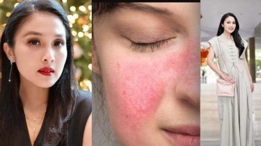 Kenali Rosacea, Penyakit yang Picu Wajah Mulus Sandra Dewi Bernanah & Harus Ganti Endorse Tas Mewah