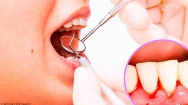 Bukan Cuma Karena Kurang Vitamin, Berikut 4 Penyebab Gusi Berdarah