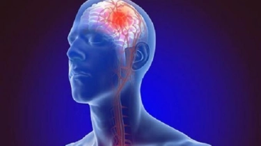 Stroke Mulai Ditemukan pada Orang Usia Muda, Dokter Ungkap Alasannya 