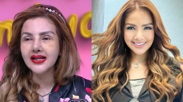 Barbie Kumalasari Ungkap Alasan Lakukan 4 Kali Operasi Hidung, Pernah Alami Infeksi hingga Bernanah