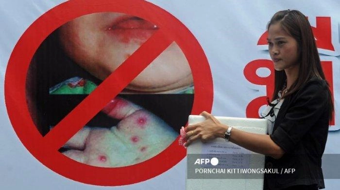 Kenali Tanda Saat Anak Kena Penyakit Tangan, Kaki dan Mulut, Ini Cara Menanganinya