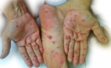 Kebersihan Jadi Kunci Pencegahan Flu Singapura Pada Anak-anak