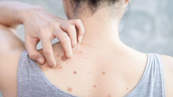 Tak Hanya Karena Sumbatan Sebum, Berikut Beberapa Penyebab Lain Jerawat Punggung