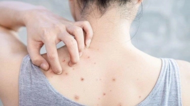 Tak Hanya Karena Sumbatan Sebum, Berikut Beberapa Penyebab Lain Jerawat Punggung
