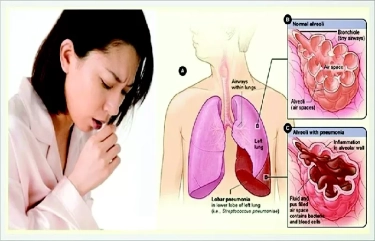 WHO Tetapkan TB Penyakit Menular Paling Mematikan, Eliminasi TB Harus dari Pencegahan Bukan Pengobatan Saja