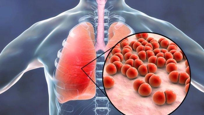 Vaksin Pneumonia Bisa Cegah Kematian Anak karena Radang Paru-paru