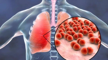 Vaksin Pneumonia Bisa Cegah Kematian Anak karena Radang Paru-paru