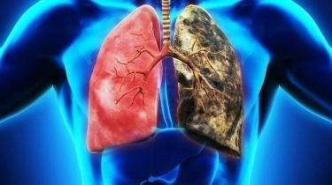 Cegah Pneumonia dengan Konsumsi Makanan Berikut Ini