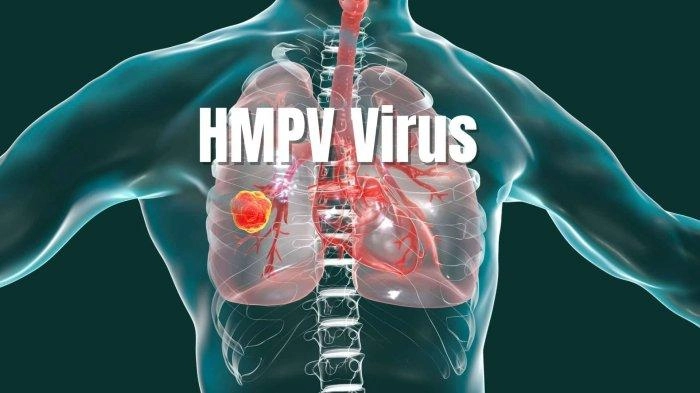 Tubuh Terpapar Virus HMPV, Ini Langkah Penanganannya 