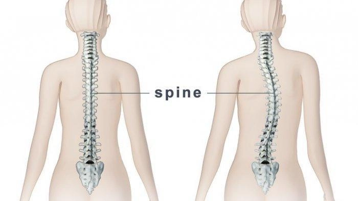 Penanganan Skoliosis yang Tepat pada Anak
