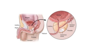 Solusi Minimal Invasif untuk Kanker Prostat Tanpa Mengganggu Fungsi Seksual