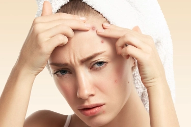 Awas, Sering Pegang Jerawat Bikin Lama Sembuh