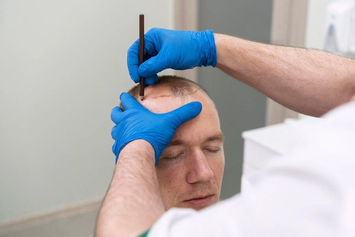 Jangan Keliru, Prosedur Transplantasi Rambut Memakai Rambut Sendiri