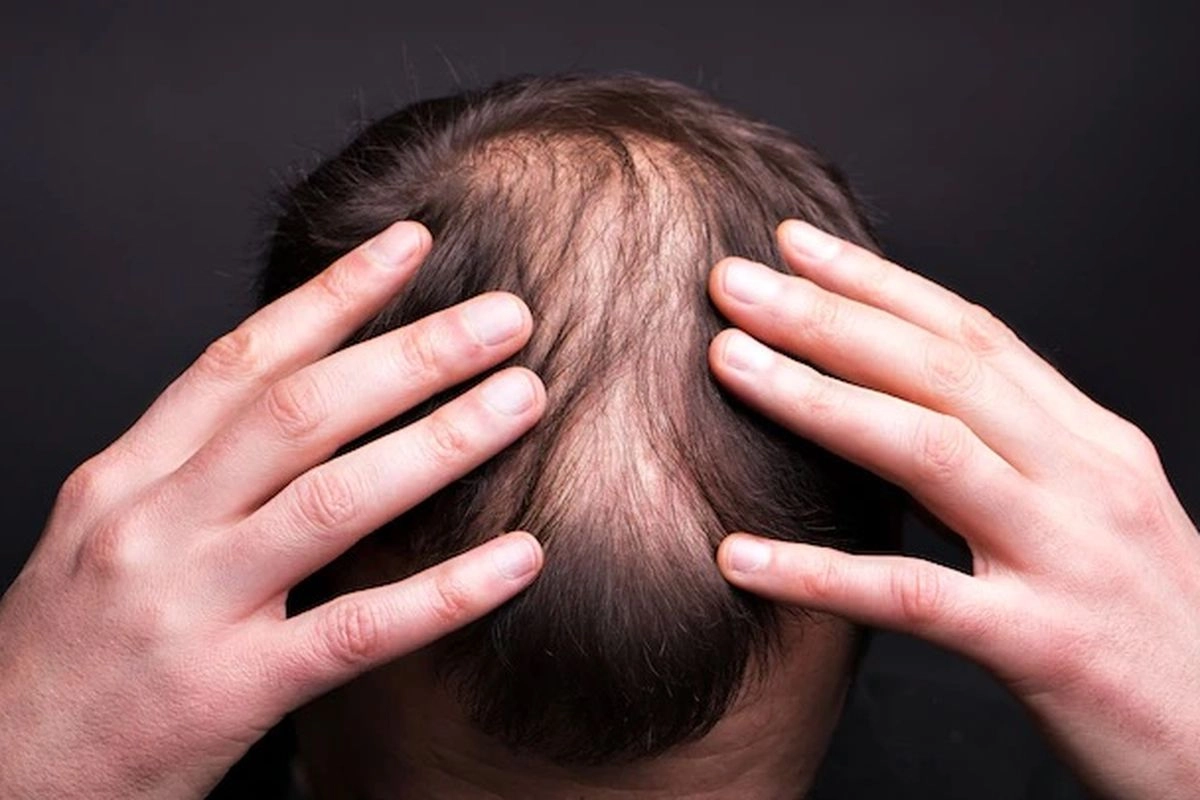 Setelah Transplantasi Rambut, Apakah Boleh Keramas?