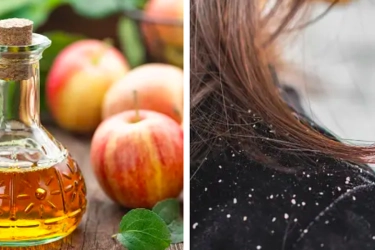 3 Masker Rambut Alami untuk Ketombe dan Kepala Gatal