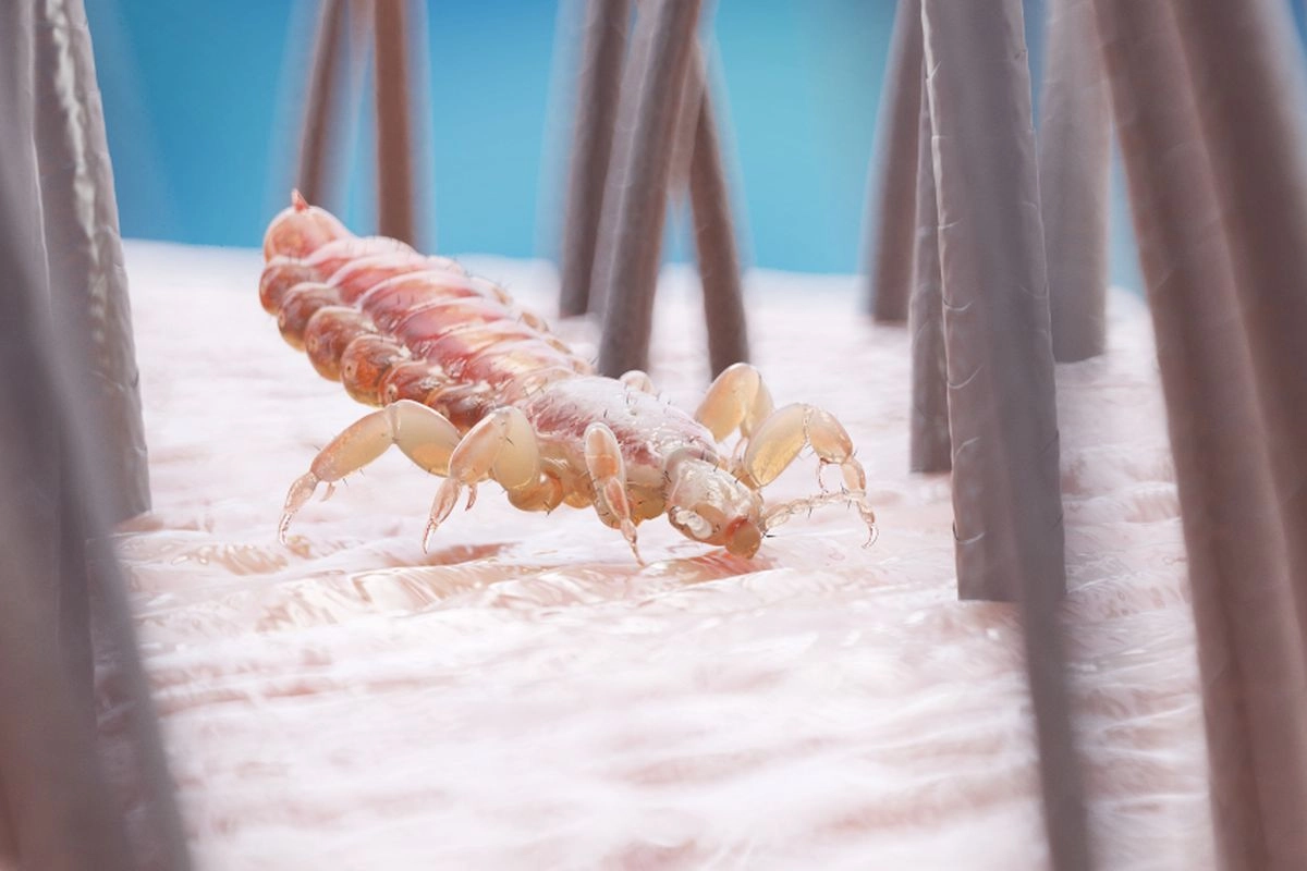 Apa yang Menyebabkan Anak-anak Terkena Kutu?