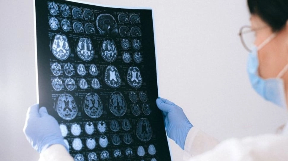 Mengenal Teknologi DSA: Terobosan Diagnosis dan Pengobatan Stroke
