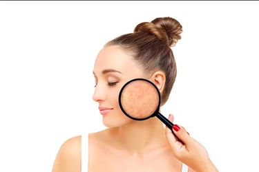 6 Cara Mengurangi Kemerahan Akibat Jerawat, Pakai Sunscreen Setiap Hari