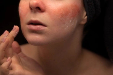 Rosacea Kambuh Saat Sedang Berjerawat, Mana yang Harus Diobati Lebih Dulu?