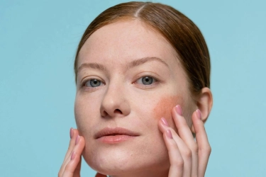 Tak Hanya Bikin Muka Merah, Rosacea Bisa Ganggu percaya Diri hingga Depresi