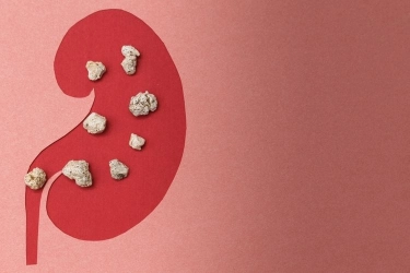 Kenali Cara Pengobatan Batu Ginjal, Ini Penjelasan Dokter Urologi
