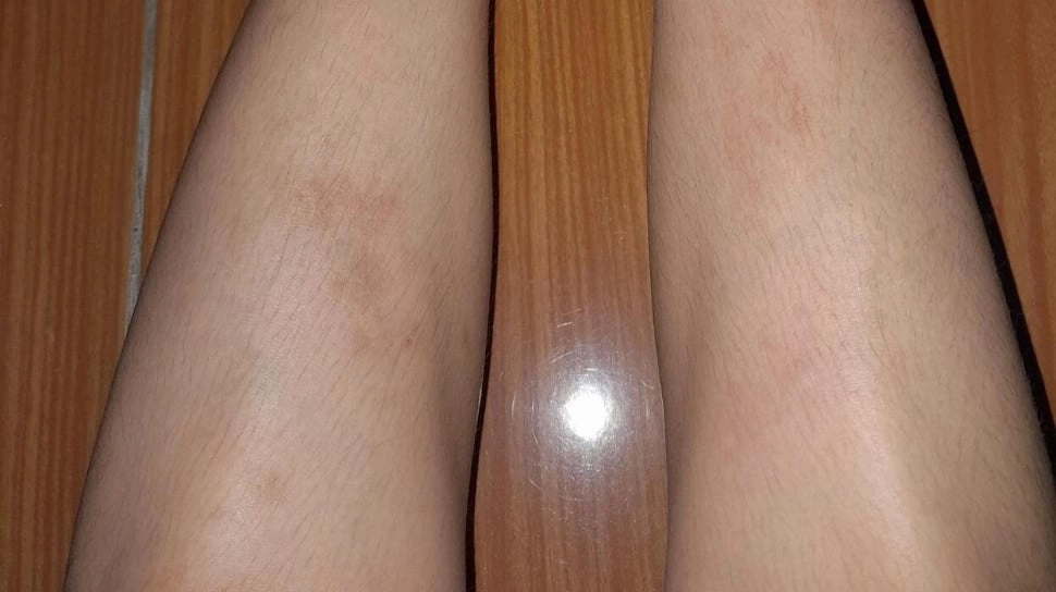 Cara Ampuh Hilangkan Bekas Luka Hitam di Tangan dan Kaki, Ini Kombinasi Skincare-nya