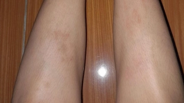 Cara Ampuh Hilangkan Bekas Luka Hitam di Tangan dan Kaki, Ini Kombinasi Skincare-nya