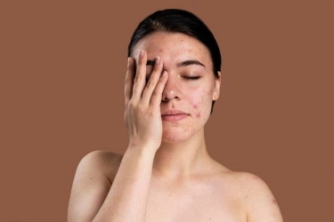 Jerawat Tak Kunjung Sembuh, Kapan Harus ke Dokter?
