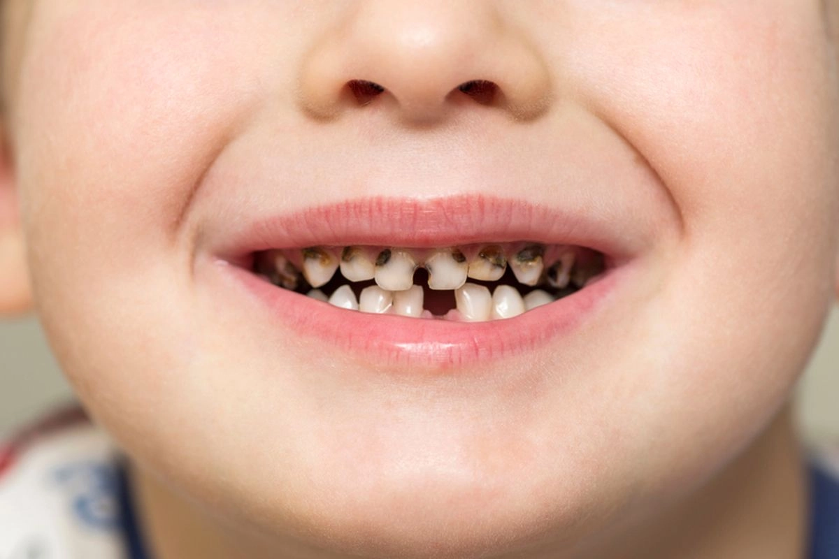 Apa Itu Nursing Bottle Caries, yang Bisa Terjadi pada Gigi Anak?