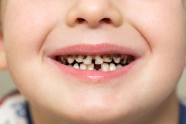 Apa Itu Nursing Bottle Caries, yang Bisa Terjadi pada Gigi Anak?