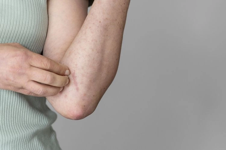 Kenali Penyebab Stevens-Johnson Syndrome: Ada Obat-obatan dan Infeksi