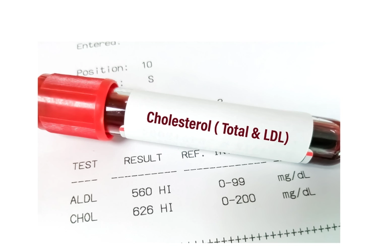 Kenali Cara Kerja Obat Kolesterol yang Umum Digunakan