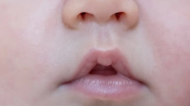 Lebih dari Sekadar Operasi, Perjalanan Panjang Perawatan Bibir Sumbing di Indonesia