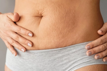 Penyebab Stretch Mark di Pinggang Wanita dan Cara Efektif Mencegahnya agar Kulit Tetap Halus