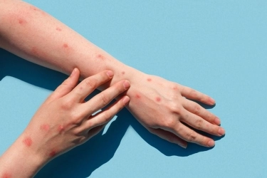 Wabah Mpox Meningkat, WHO Umumkan Status Darurat Kesehatan Global