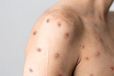 WHO Perpanjang Status Darurat Mpox, Ini yang Perlu Diperhatikan…