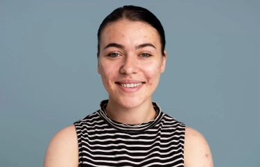 5 Cara Mengatasi Jerawat Hormonal Ringan