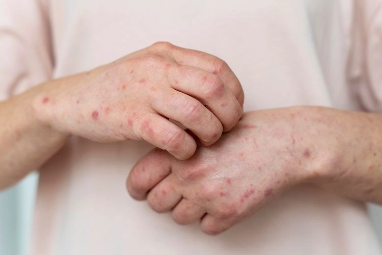 Mpox Bisa Menular Cepat: Ini Tindakan Pencegahan yang Bisa Dilakukan
