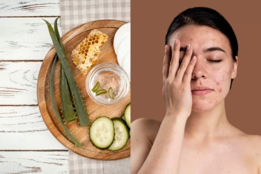 4 Rekkomendasi Masker Aloe Vera untuk Hilangkan Jerawat